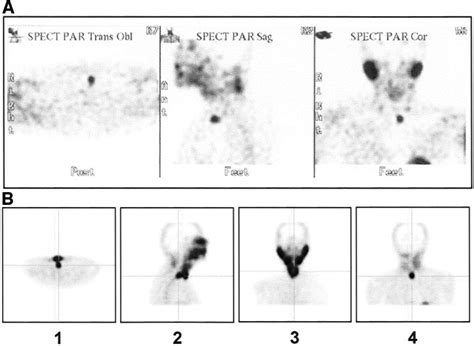 Anatomic Localization Of Ectopic Parathyroid Adenomas By 99m