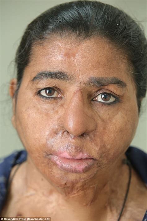 Women Scarred By Acid Attacks Have Reconstructive Surgery Daily Mail