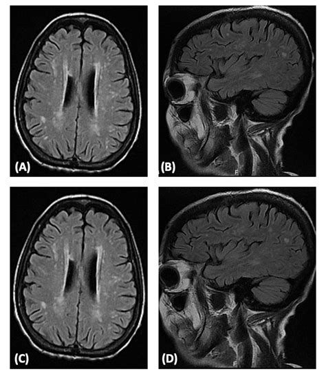 Mri Brain Axial View A And Sagittal View B T2 Flair Suggest