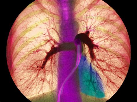 Coloured Angiogram Showing The Pulmonary Arteries Photograph By Fine