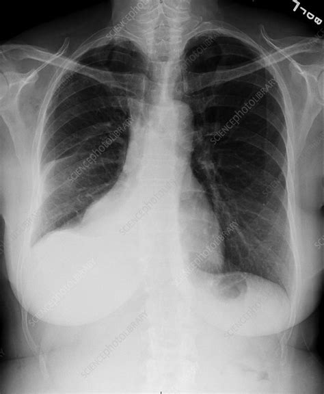 Pleural effusion symptoms include shortness of breath or trouble breathing, chest pain, cough, fever what procedures and tests diagnose pleural effusions? Pleural effusion, X-ray - Stock Image - C036/6434 ...