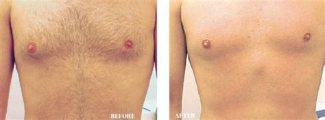 Never again will you have to worry about waxing, shavi. Dermology Hair Removal Cream 1 Month Supply | Dermology.us