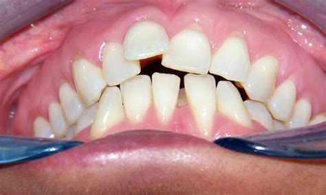 Why Having Crooked Teeth Can Effect Your Health Directorio Odontológico