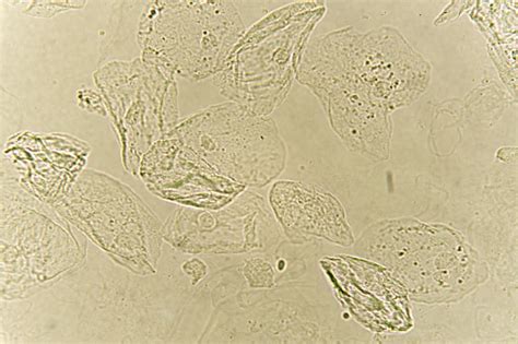 Sel Epitel Dengan Bakteri Dalam Urin Pasien Foto Stok Unduh Gambar Sekarang Analisis