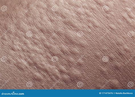Irritated Human Skin Texture Covered With Allergic Bumps And Pimples