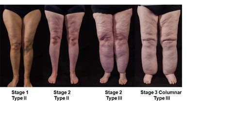 Table Examination Of Subcutaneous Fat For Lipedema With Or Without