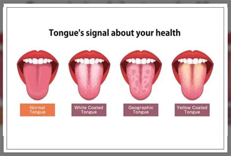 White Tongue Causes And Treatment Repc