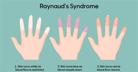 Raynauds Phenomenon Foot Right Podiatry