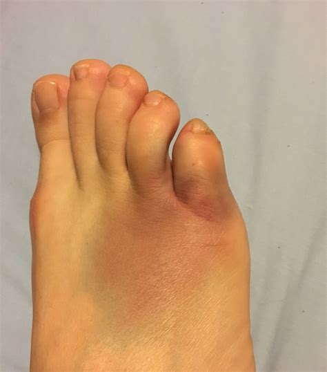 Broken Big Toe Symptoms