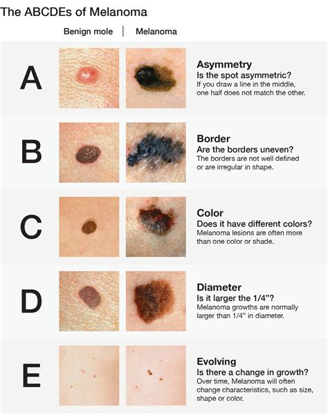 Skin Cancer Screening New York Dermatology Group