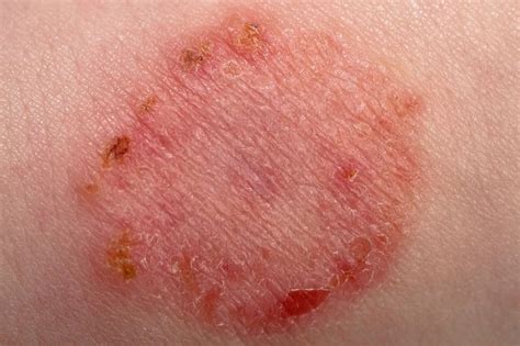 Rashes In Babies And Children Nhs