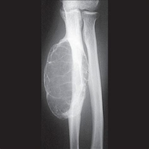 A X Ray Of Aneurysmal Bone Cyst Abc Of Right Humerus In A Year Old
