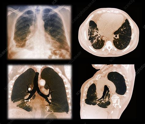 Kaposis Sarcoma Of The Lung Ct Scans Stock Image C0132187