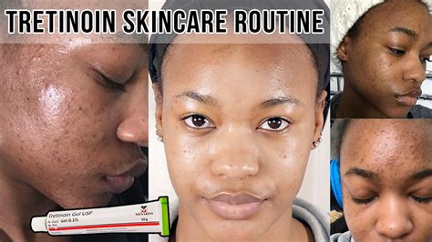 How To Get Rid Of Acne And Acne Scars Tretinoin Skincare Routine