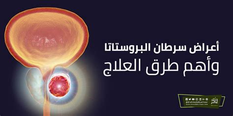يعتبر سرطان البروستاتا من أكثر أنواع السرطان شيوعاً لدى الرجال، وغالباً ما يكون هذا النوع من السرطان بطيء النمو، ويمكن علاجه بنجاح وفعالية عند. تعرف على 9 من اسرار أعراض سرطان البروستاتا وأهم طرق العلاج