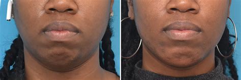 Chin Implant Before And After Photo Gallery