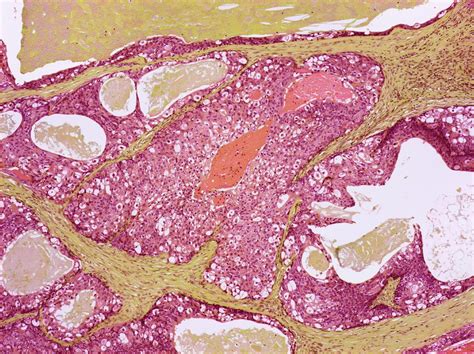 Salivary Gland Cancer Photograph By Steve Gschmeissner Pixels