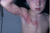 Images of Can Kids Get Shingles
