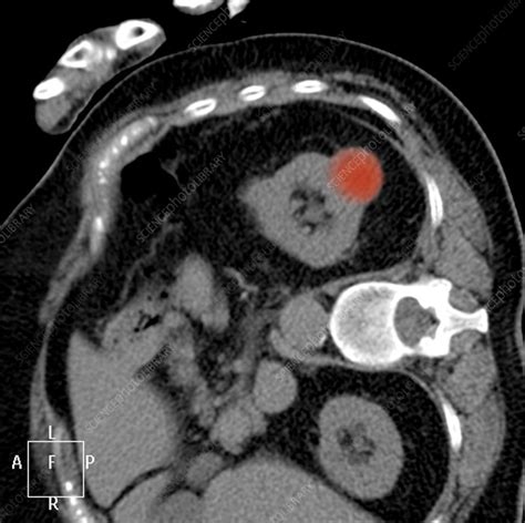 Kidney Cancer Ct Scan Stock Image C0107598 Science Photo Library