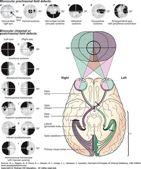 Visual Fields Visual Tracts Vision Therapy Occupational Therapy