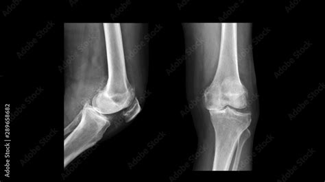 Film X Ray Knee Radiograph Show Degenerative Osteoarthritis Disease Oa