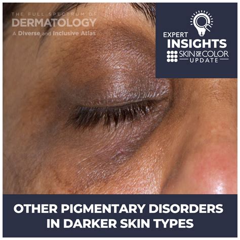 Other Pigmentary Disorders In Darker Skin Types Next Steps In Dermatology