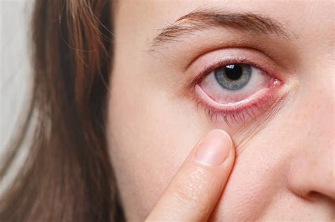 The Best Ways To Treat Eye Allergies Paramedics World