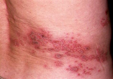 Herpes Zoster Syn Shingles