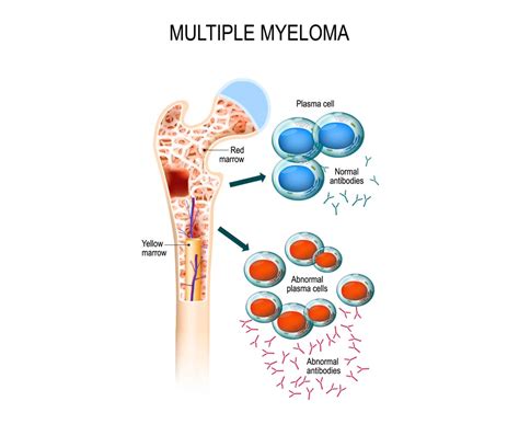 Multiple Myeloma Diag2tec Preclinical Cro In Mm Lymphoma Leukemia