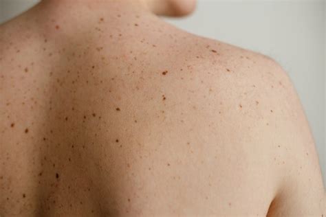 When To Be Concerned About Mole And See A Dermatologist