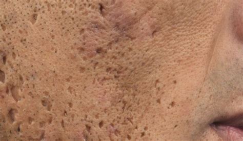 Removal Of Face Acne Scars Raised Pitted Or Darkened Skincarederm