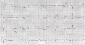 Middle aged patient presenting with chest. STEMI equivalents - WikEM