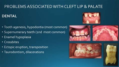 Principles Of Cleft Lip And Palate Formation