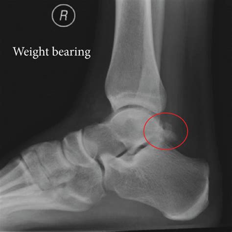 Lateral Radiograph Of Right Ankle Demonstrating A Prominent Fractured