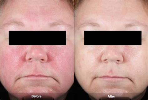 Laser Treatment For Rosacea Before And After Uv Blue Light Acne