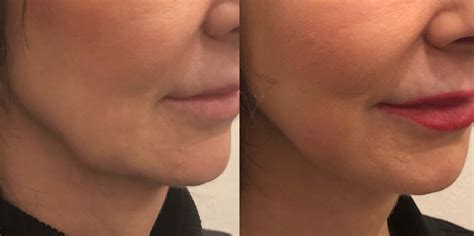 Kybella For Jowls A Game Changer