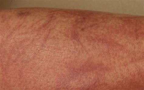 Shiitake Dermatitis Symptoms Causes Diagnosis Treatment