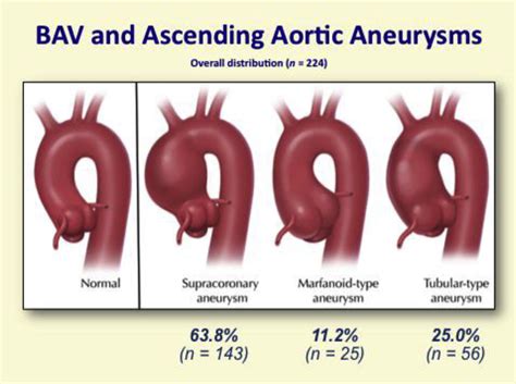 Anatomic Distribution Of Aortic Aneurysms In Patients With Bav Bav