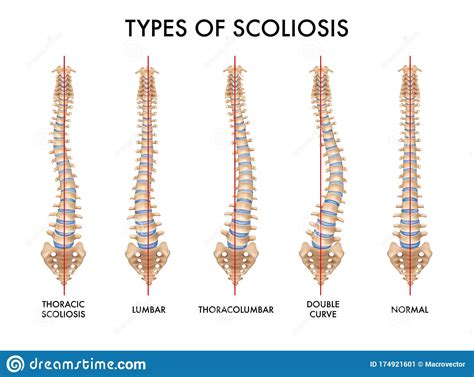 Scoliosis Degrees Of Curvature Chart 57 Off La