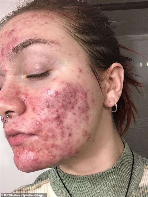 Woman Whose Cystic Acne Left Her In Extreme Pain And Suicidal Finds