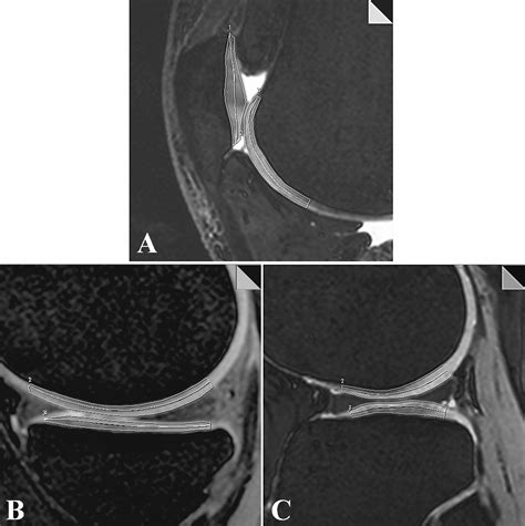 Quantitative T2 Assessment Of Knee Joint Cartilage After Running A
