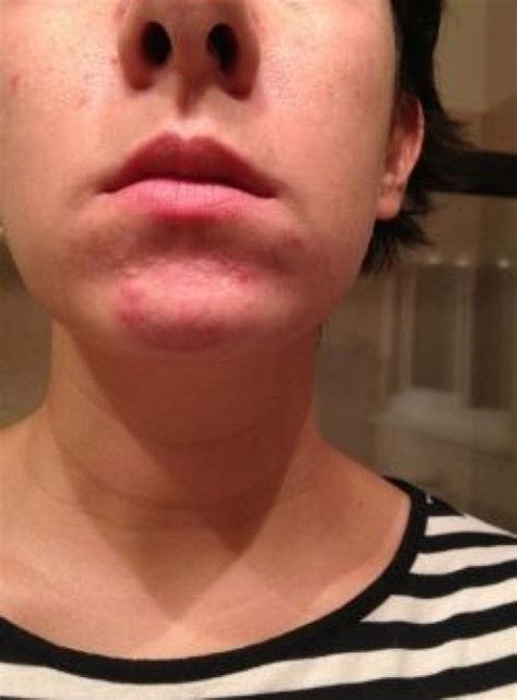 Acne On The Chin Is Often Caused By Hormonal Fluctuations