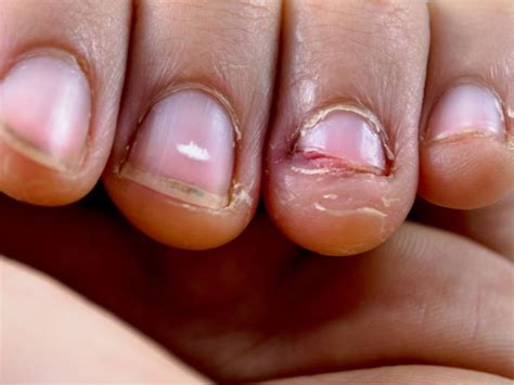 Biting The Skin Around Your Nails Anxiety Nail Ftempo