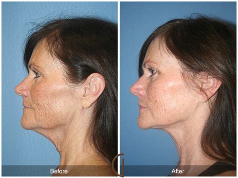 Facelift Fifties Before And After Photos Patient 66 Dr Kevin Sadati