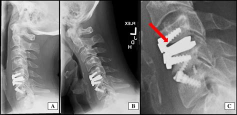 This Patient Had A C56 Cervical Disc Arthroplasty And A C67 Fusion For