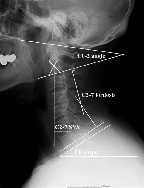 Radiological Parameters The C27 Sagittal Vertical Axis The Distance