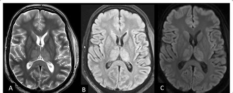 Hypoxic Ischemic Encephalopathy Mri Images Showing Bilateral