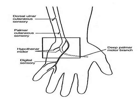 Ulnar Neuropathy At Wrist Electrophysiological Approache