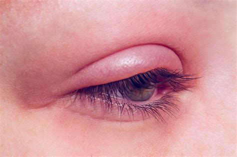 Posterior And Anterior Blepharitis Eyelid Inflammation