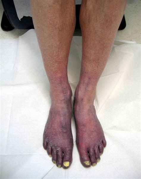 Acrocyanosis Causes Symptoms Diagnosis And Acrocyanosis Treatment